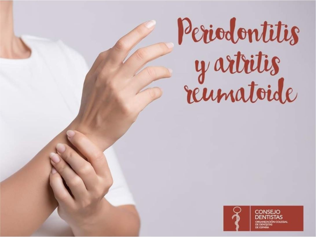 Periodontitis, Artritis reumatoide